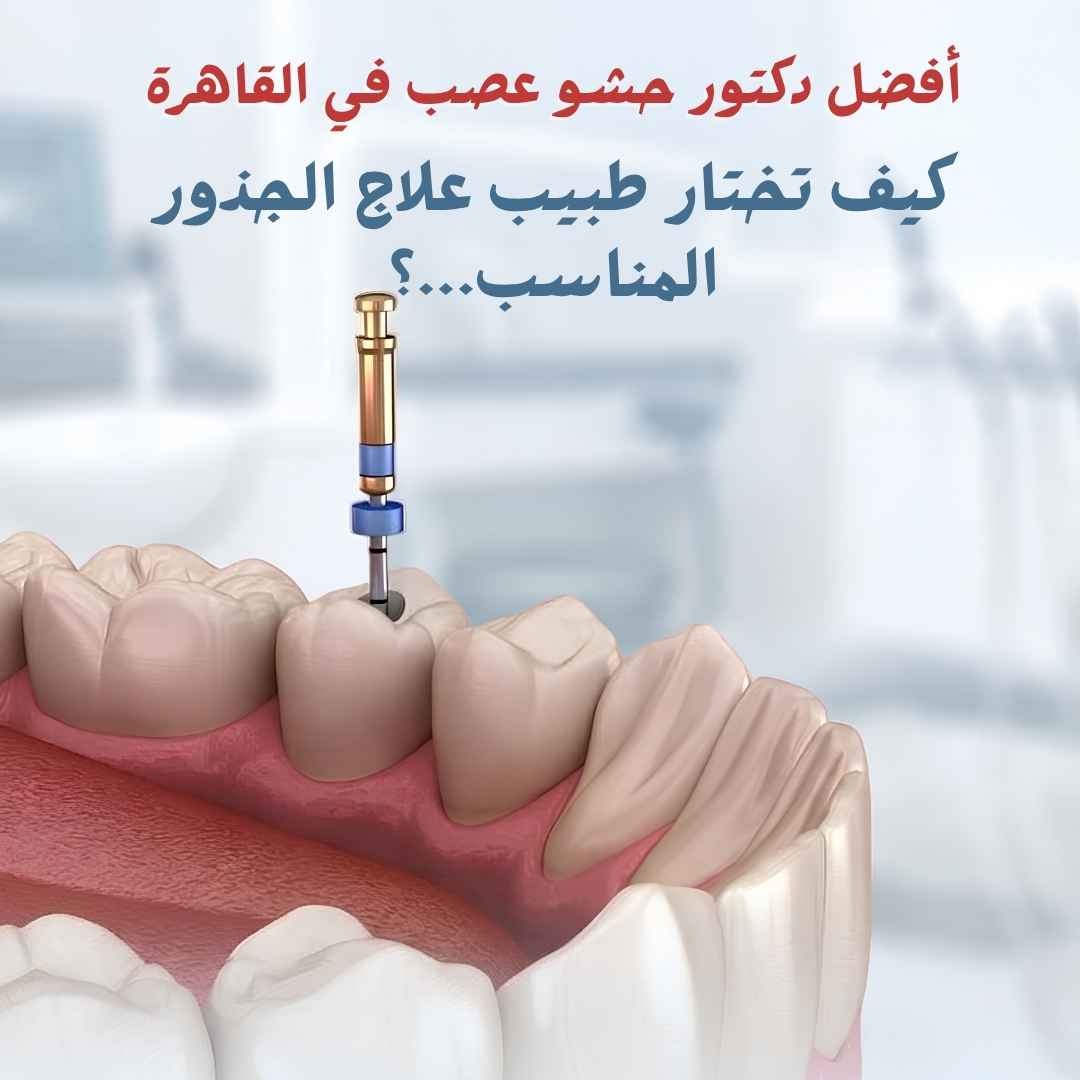 أفضل دكتور حشو عصب في القاهرة يجري علاج الجذور باستخدام أحدث التقنيات للحفاظ على الأسنان الطبيعية